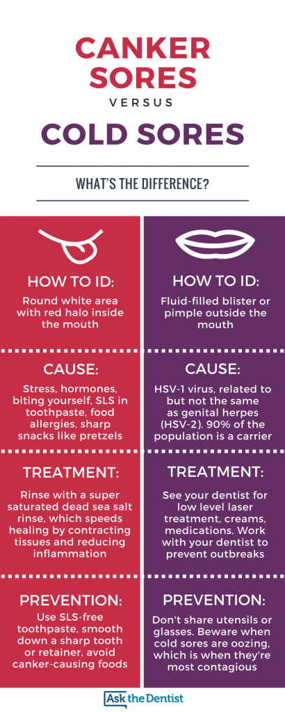 Cold Sores vs. Canker Sores